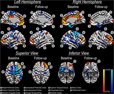 Bilateral Amygdala Radio-Frequency Ablation for Refractory Aggressive Behavior Alters Local Cortical Thickness to a Pattern Found in Non-refractory Patients